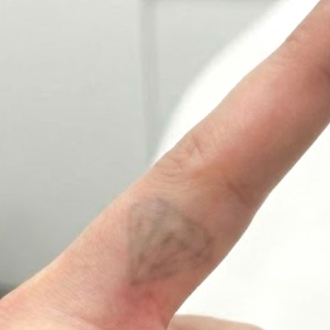 Après détatouage