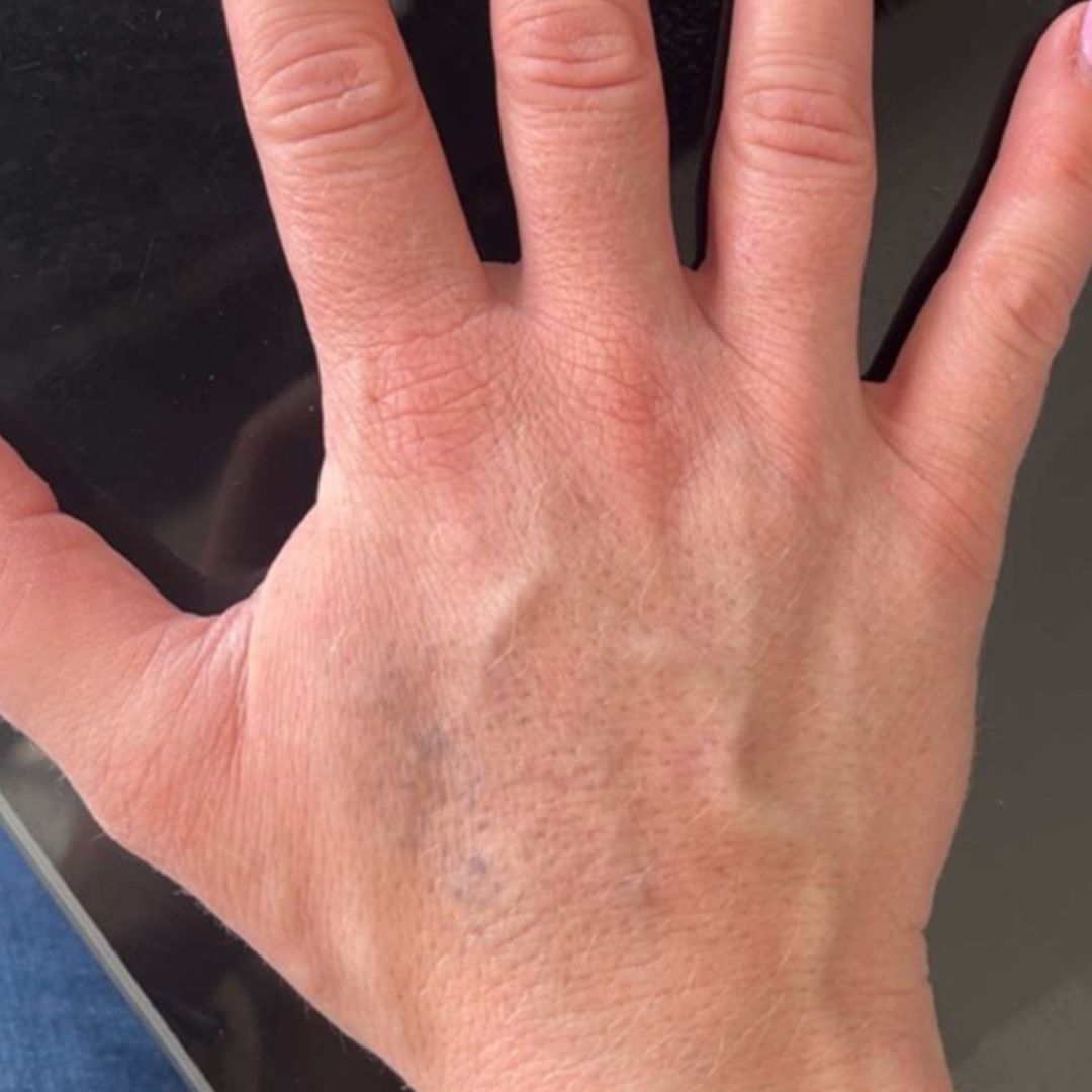 35